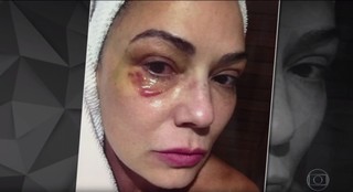 Luiza Brunet em foto feita após agressão que ela afirma ter sofrido do ex-marido, Lírio Parisotto (Foto: Reprodução TV Globo / Fantástico)