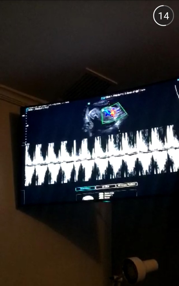 Laura Fernandes, nora de Preta Gil, mostra imagens da ultrassonografia (Foto: Snapchat / Reprodução)