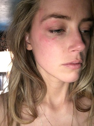 Amber Heard mostra rosto após suposta agressão (Foto: Reprodução/People)