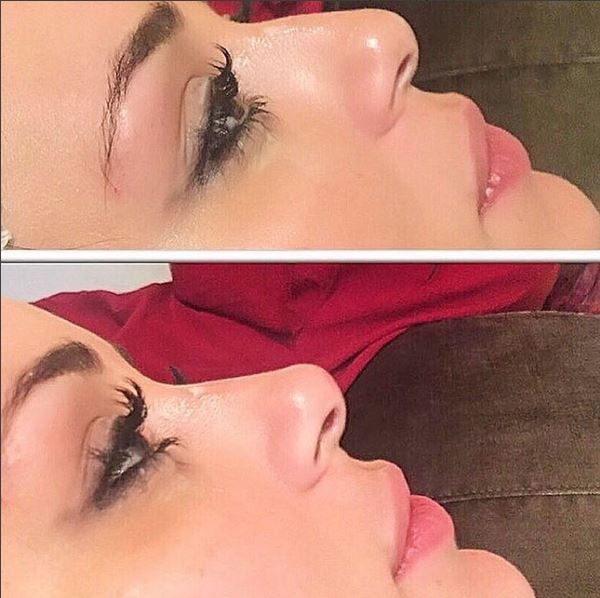 Ex-BBB Letícia Santiago mostra resultado de preenchimento no nariz e compara o antes e depois (Foto: Reprodução do Instagram)