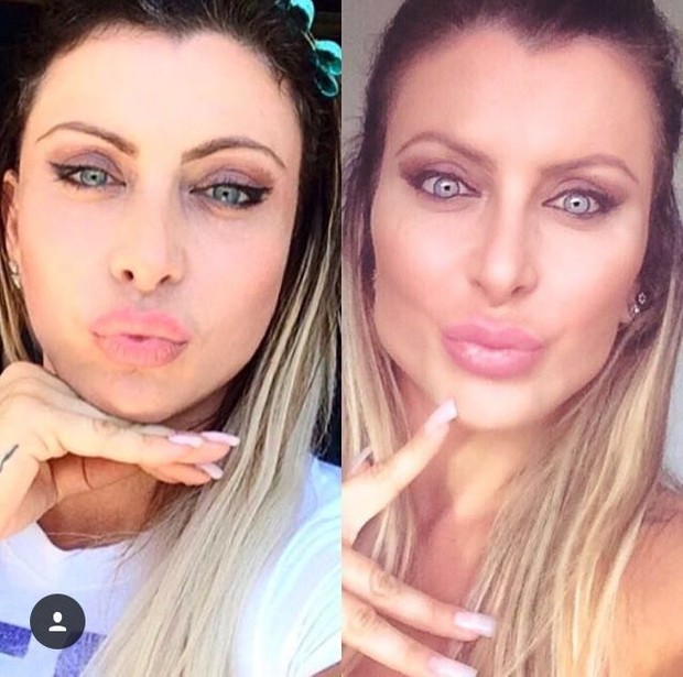 Luciana Hoepers mostra antes e depois de cirurgia (Foto: Arquivo Pessoal/Divulgação)