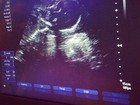Perlla posta foto do ultrassom da sua segunda filha