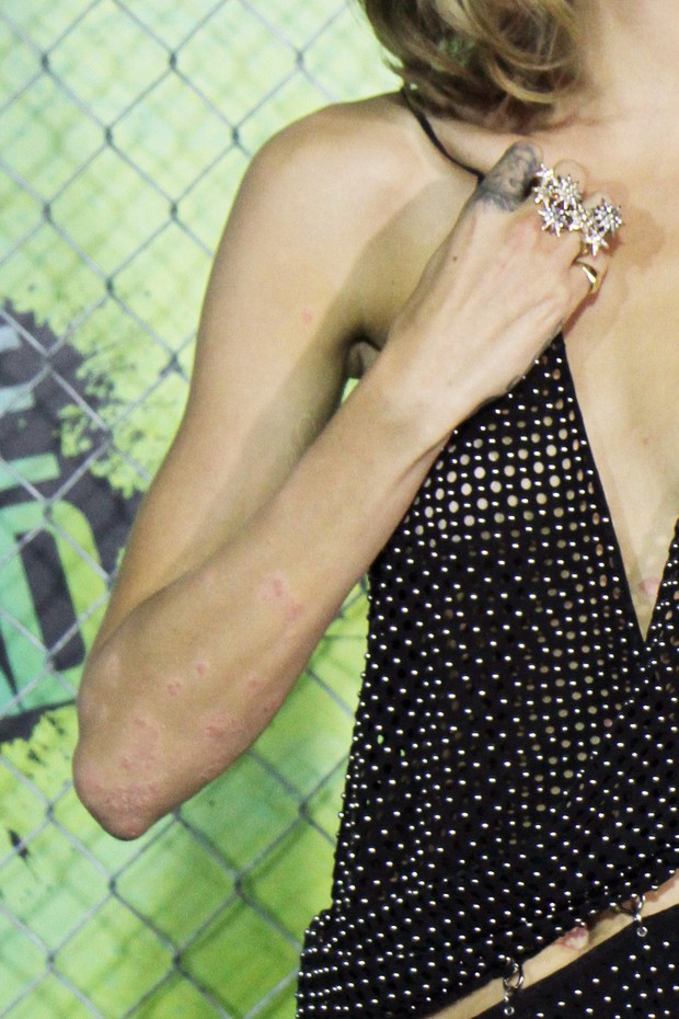 Marcas no braço de Cara Delevingne  (Foto: AKM-GSI)