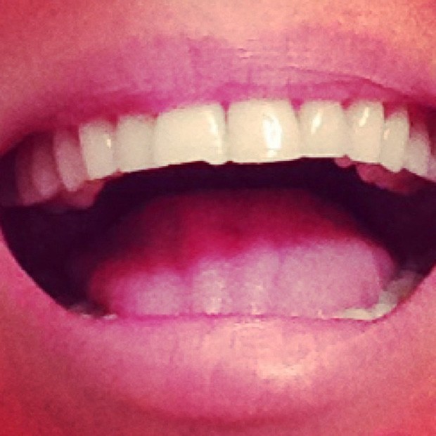 Ellen Jabour posta foto do dente quebrado (Foto: Instagram / Reprodução)