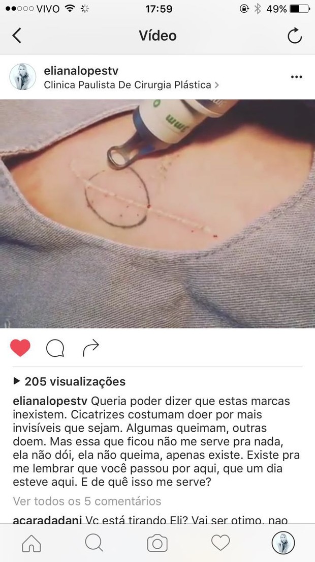 Elaana Amaral apaga tatuagem (Foto: Reprodução/Arquivo Pessoal/Divulgação)