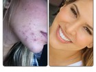 Ex-BBB Adriana mostra antes e depois de sua pele
