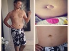 David Brazil posta imagem de antes e depois da cirurgia de hérnia umbilical