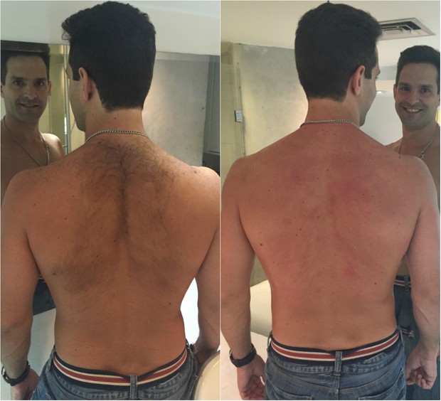 Antes e depois da depilação: Iran Malfitano retira os pelos das costas com cera quente e diz que dói demais (Foto: Divulgação)