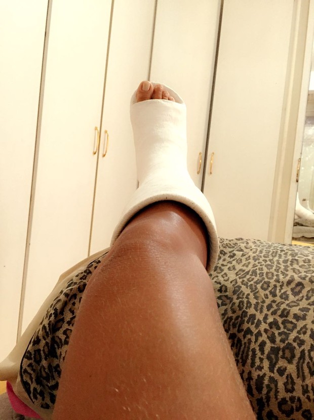 Solange Gomes quebra o tornozelo  (Foto: Arquivo Pessoal)