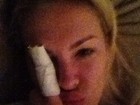 Ana Hickmann mostra dedo machucado em rede social