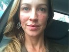 Luana Piovani mostra rosto inchado em selfie: 'Parece picada de abelha'