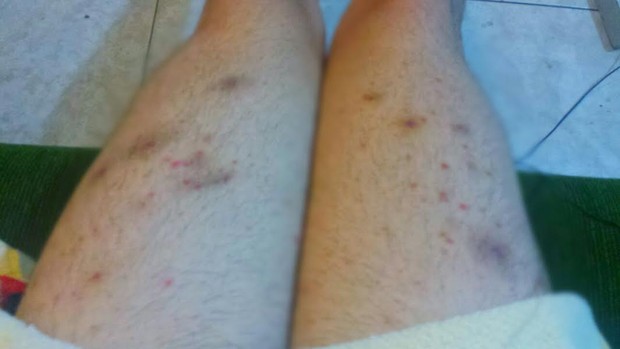 Infecção nas pernas de Ken Humano (Foto: Divulgação)
