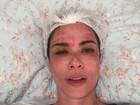 Luciana Gimenez mostra sangue no rosto após tratamento estético