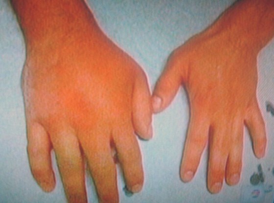 Mão quebrada Zac Efron  (Foto: Reprodução / Twitter)