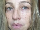 Luana Piovani mostra rosto com marcas após procedimento estético