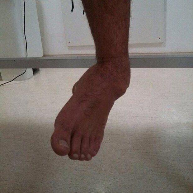 Kiko Pissolato posta foto do pé machucado (Foto: Instagram / Reprodução)