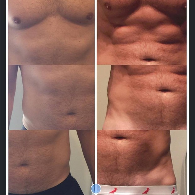 Fotos do antes e depois do tratamento feito por Alexandre Barillari na abdômen (Foto: Arquivo Pessoal)