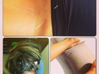 Ex-BBB Adriana posta foto em sessão de acupuntura: 'É uma delícia'