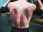 Filho de Madonna exibe as costas machucadas após prática esportiva