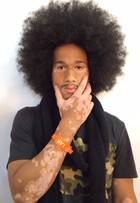 Sam Gonçalves, modelo com vitiligo, estreia no SPFW: 'Espero causar'