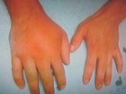 Zac Efron quebra a mão durante filmagens e mostra foto na web