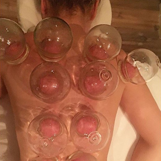 Thalia mostra tratamento com ventosas (Foto: Instagram/ Reprodução)