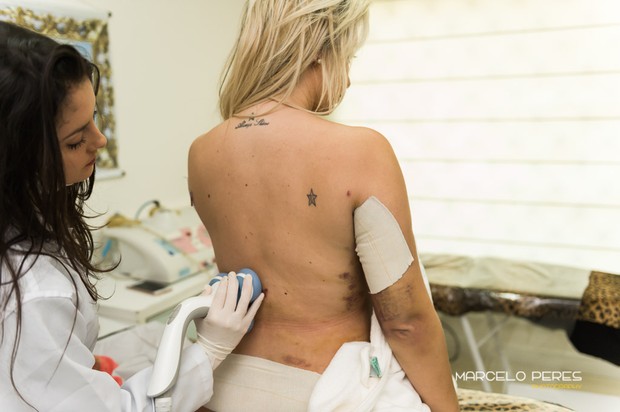 Veridiana Freitas faz tratamento estetico após lipoaspiração (Foto: Marcelo Peres / Divulgação)