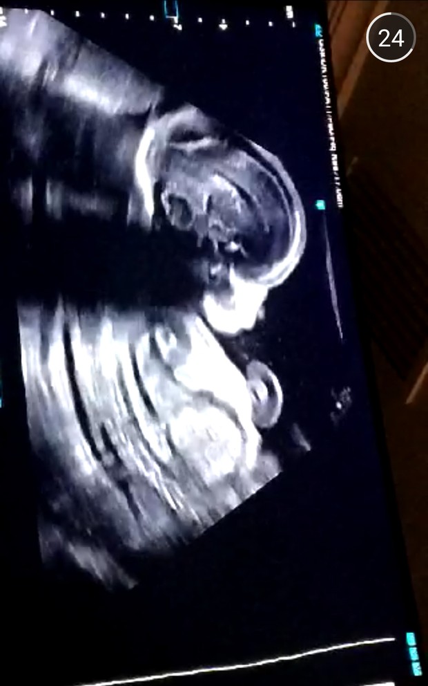 Laura Fernandes, nora de Preta Gil, mostra imagens da ultrassonografia (Foto: Snapchat / Reprodução)