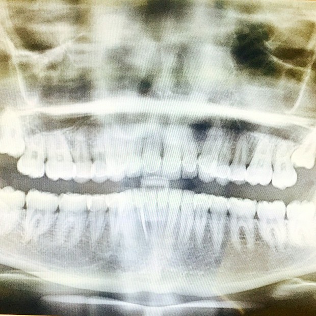 Raio-X da arcada dentária de Miley Cyrus (Foto: Reprodução/Instagram)