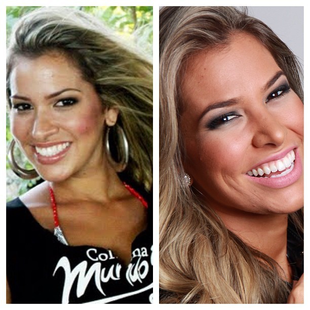 Adriana Santanna mostra antes e depois do nariz em foto (Foto: Reprodução/Instagram)