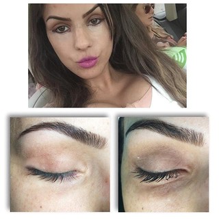 Resultado da cirurgia nso olhos de Carol Dias (Foto: Reprodução/Instagram)