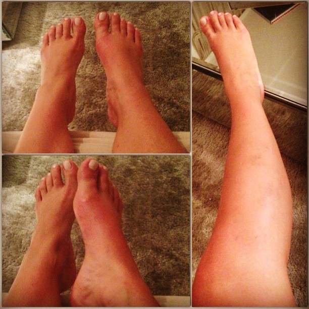 Renatinha mostra pé machucado no Instagram (Foto: Reprodução/Instagram)