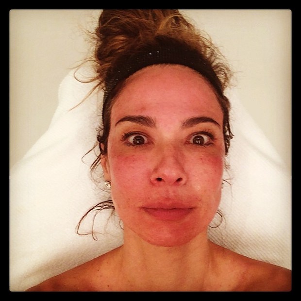 Luciana Gimenez exibe rosto vermelho após tratamento estético (Foto: Instagram/ Reprodução)