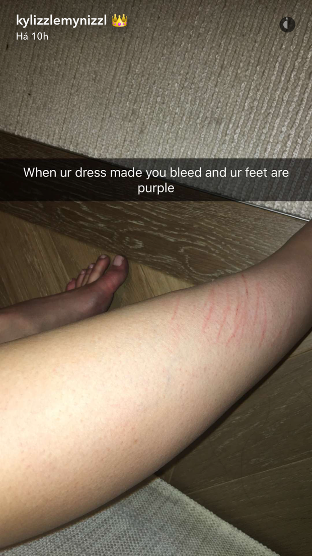 Kylye Jenner mostra perna arranhada após evento (Foto: Reprodução / Snapchat)