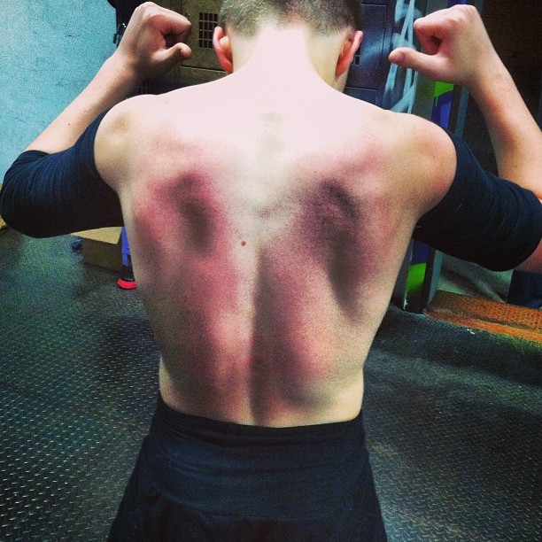 Rocco, filho de Madonna, exibe as costas machucadas (Foto: Instagram/ Reprodução)